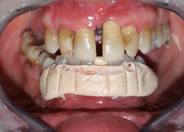 Impacco parodontale