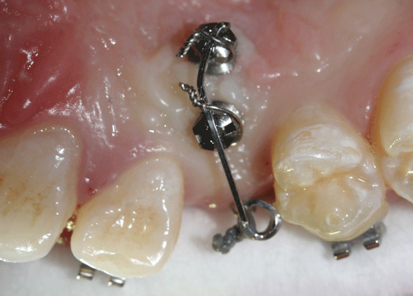 Mini impianti ortodontici