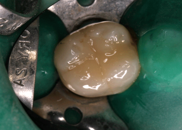 Otturazione in materiale estetico