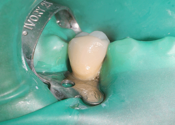 Cementazione di una corona in zirconio-ceramica